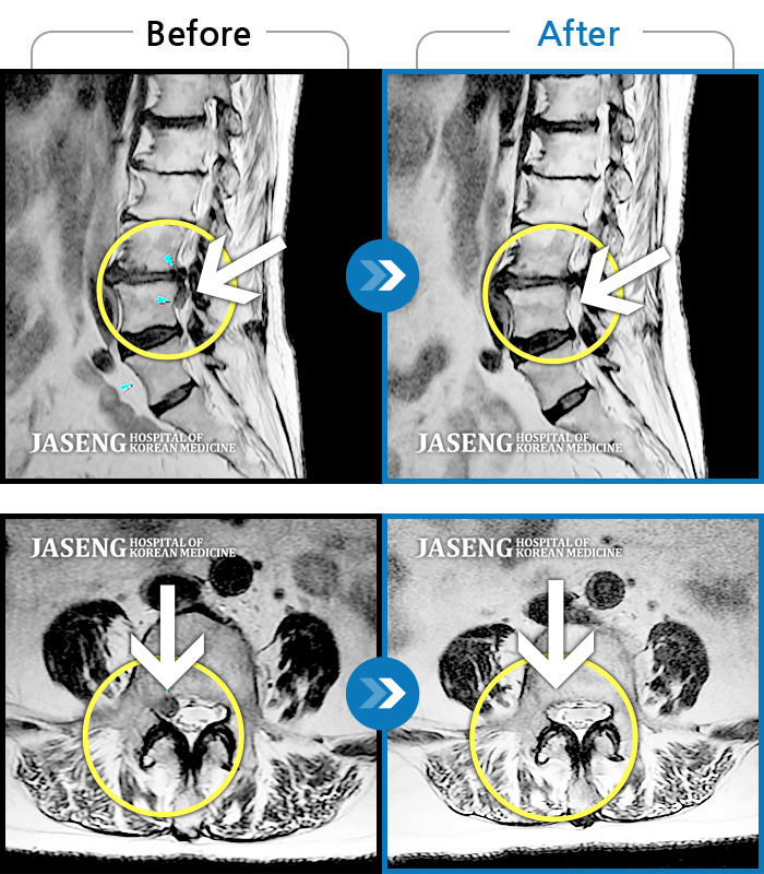 광화문자생한방병원 치료사례 MRI로 보는 치료결과-우측 허리, 엉치에서 발목까지 통증이 심했다.