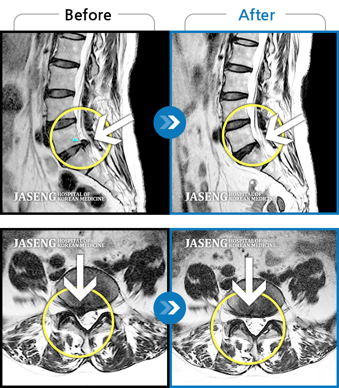 광화문자생한방병원 치료사례 MRI로 보는 치료결과-허리 골반이 욱신욱신하게 아프고 대퇴부 뒤쪽으로 통증과 저림이 심했다.