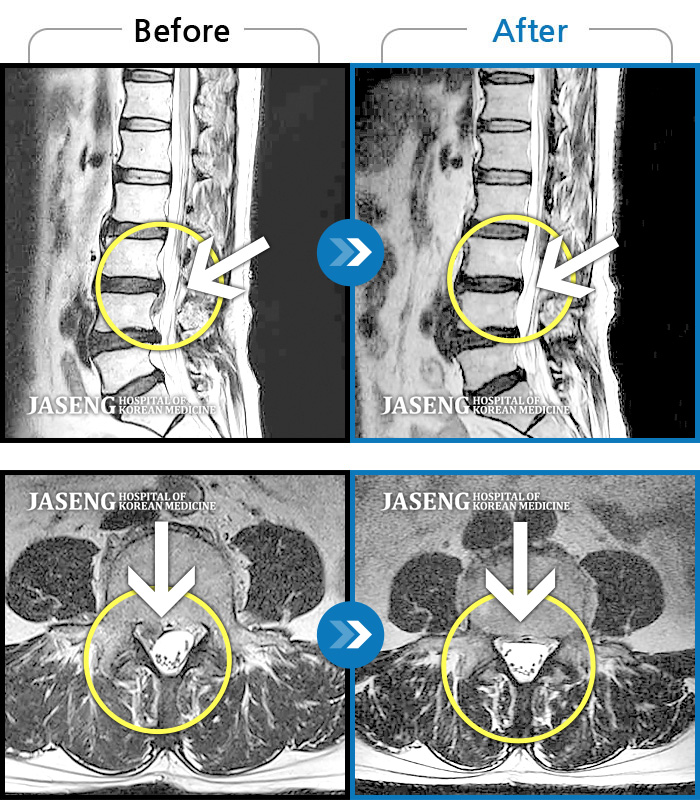 �Ȼ��ڻ��ѹ溴��_MRI ġ�� ���� ���