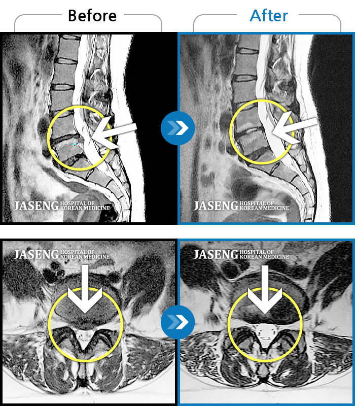 광화문자생한방병원 치료사례 MRI로 보는 치료결과-허리와 우측 허벅지, 다리 바깥쪽으로 통증과 저림이 심했다. 