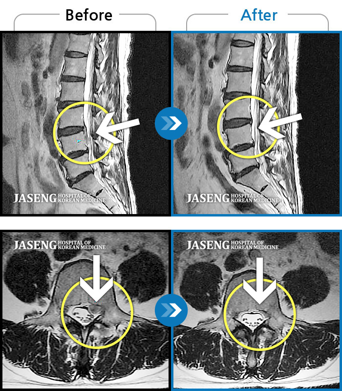 광화문자생한방병원 치료사례 MRI로 보는 치료결과-우측 다리가 당겨서 걷기가 불편했다.