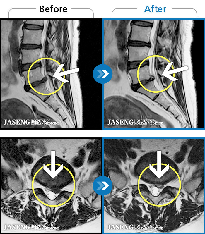 Ȼڻѹ溴 ġ MRI  ġ-㸮   ְ ٸ   ȱⰡ .