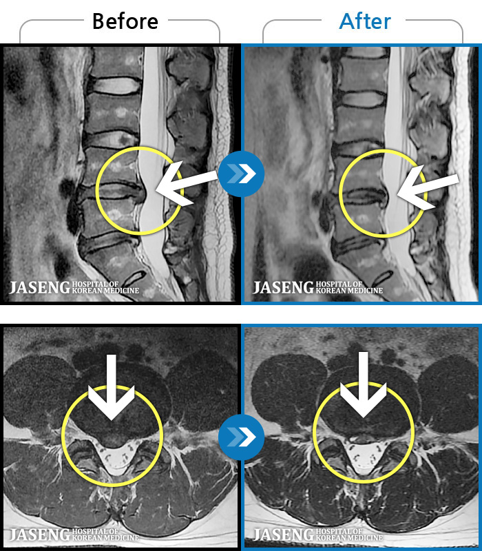 Ȼڻѹ溴 ġ MRI ġ- 㸮