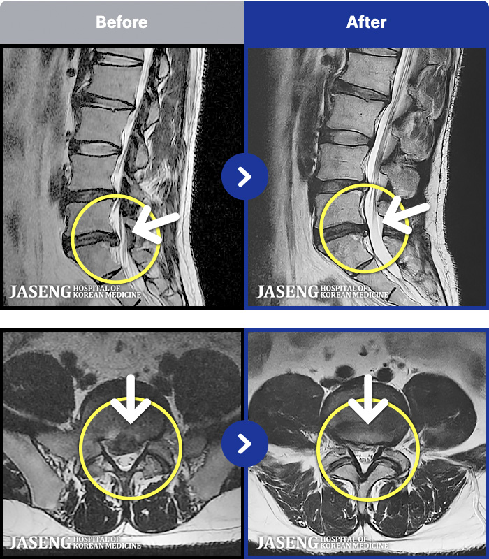 ���ڻ��ѹ溴�� ġ���� MRI�� ���� ġ����-�ؿ� ü�� �� �ް��� ���� ��ȭ�� ȥ�� �ȴ°� ��������.