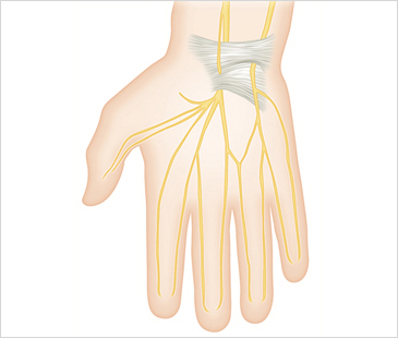 광화문자생한방병원 기타관절질환 손목터널증후군-손목터널증후군에 관련된 이미지 입니다.