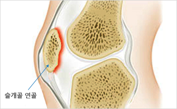 광화문자생한방병원 무릎질환 슬개골연골연화증-슬개골 연골이 위치해 있는 무릎 설명 이미지