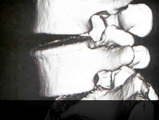 광화문자생한방병원 허리질환 퇴행성디스크-정상척추에 관련된 이미지 입니다.