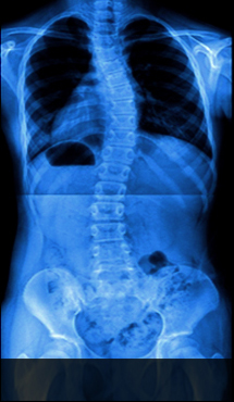 광화문자생한방병원 허리질환 척추측만증-척추측만증에 관련된 이미지 입니다.