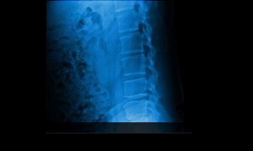광화문자생한방병원 허리질환 척추후만증-척추후만증에 관련된 이미지 입니다.