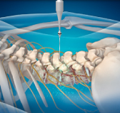 광화문자생한방병원 허리치료법 신경근회복술-신경근회복술의 특징 두번째 관련 사진 입니다.